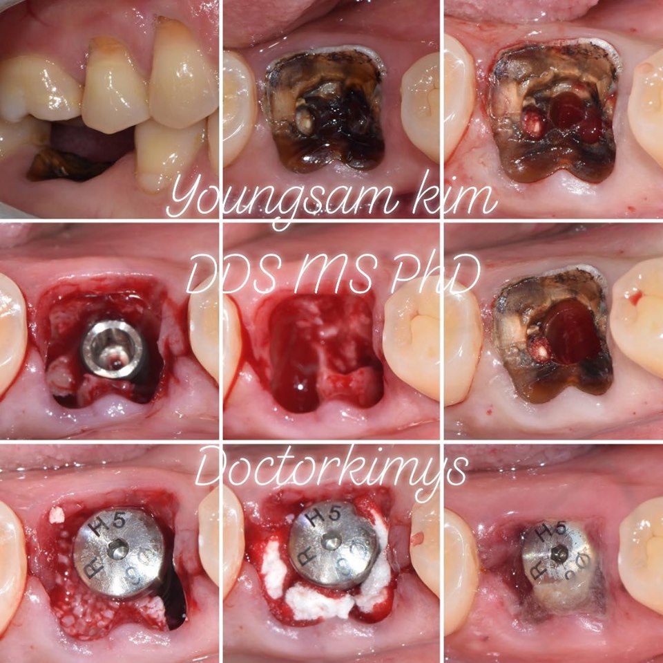 강남레옹치과 원데이 임플란트, 발치 즉시 식립까지 완료 관련 이미지 3