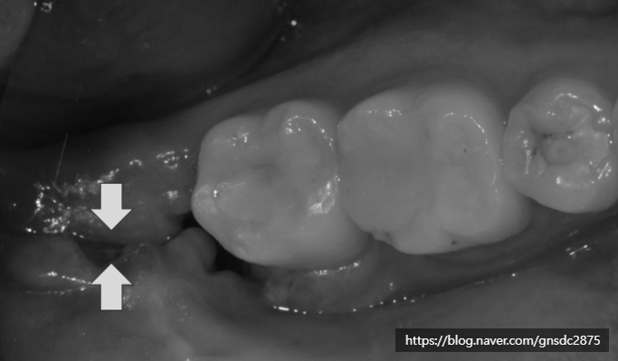 사랑니 발치 후 구멍, 음식물 끼임부터 회복, 관리법까지 총정리📑 / 강남레옹치과 관련 이미지 5