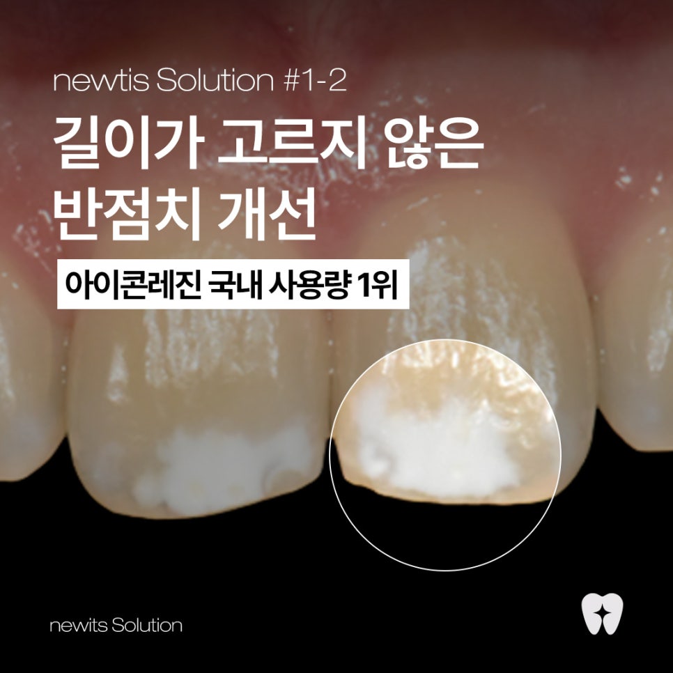 길이가 고르지 않은 반점치, 뉴티스 솔루션 / 아이콘레진 국내 사용량 1위 치과 관련 이미지 1