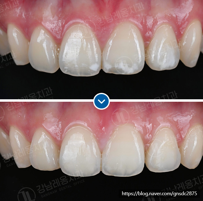 뉴티스 치아성형✨ 살짝 깨진 앞니, 뾰족한 송곳니 다듬기 / 강남레옹치과 관련 이미지 4