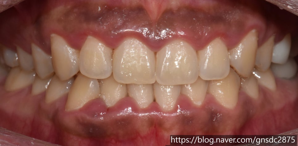 뉴티스 잇몸미백✨ 웃을 때 드러나는 검은 잇몸 개선 / 강남레옹치과 관련 이미지 5