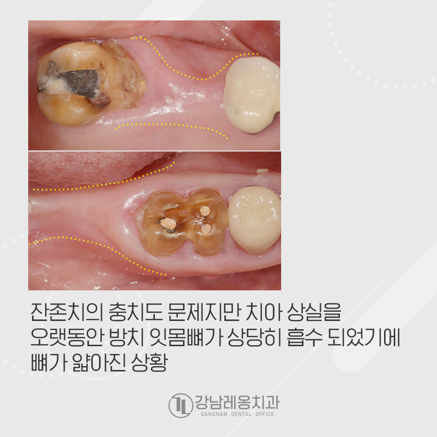 어금니 충치 미루면 임플란트 수술 할 때 뼈이식도 관련 이미지 3