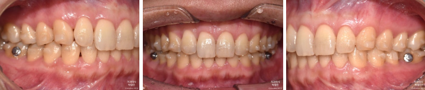 치과의사가 직접 경험한 인비절라인 특징과 진행과정👨&zwj;⚕️ / 강남레옹치과 관련 이미지 6