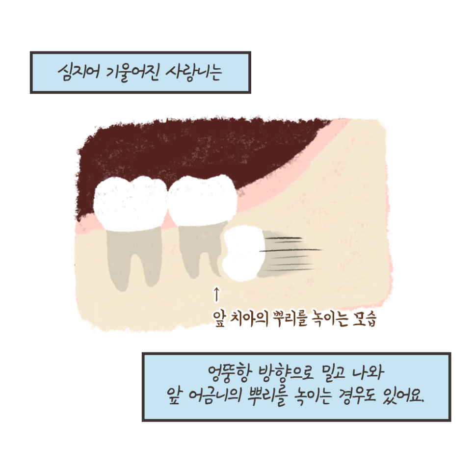 사랑니 발치 이유!! 최악의 경우 이렇게까지 된다..? (냐폴레옹툰 7화) 관련 이미지 9