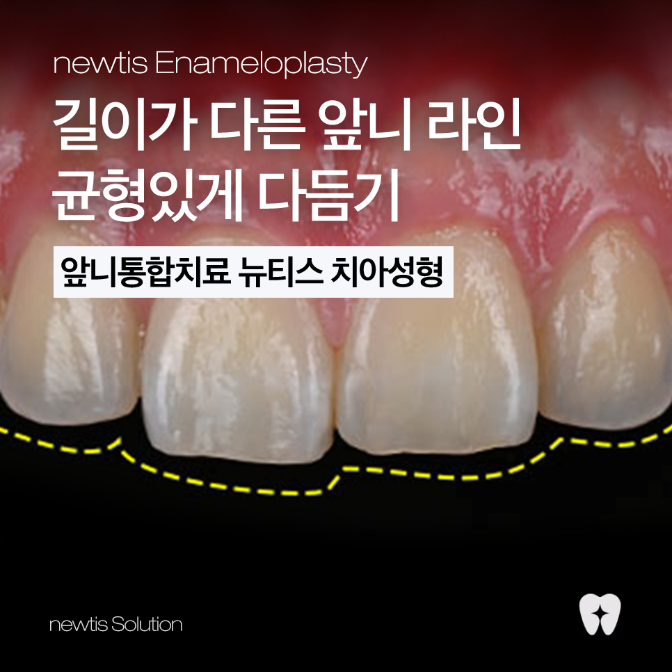 앞니 끝이 살짝 깨졌다면? 뉴티스 치아성형으로 자연스럽게 치아라인 정리하기 관련 이미지 1