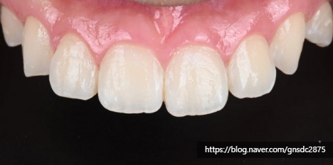교정 후 치아에 백색반점이? 교정 후 치아탈회 삭제없이 뉴티스 반점치 치료 (아이콘레진) / 강남레옹치과 관련 이미지 5