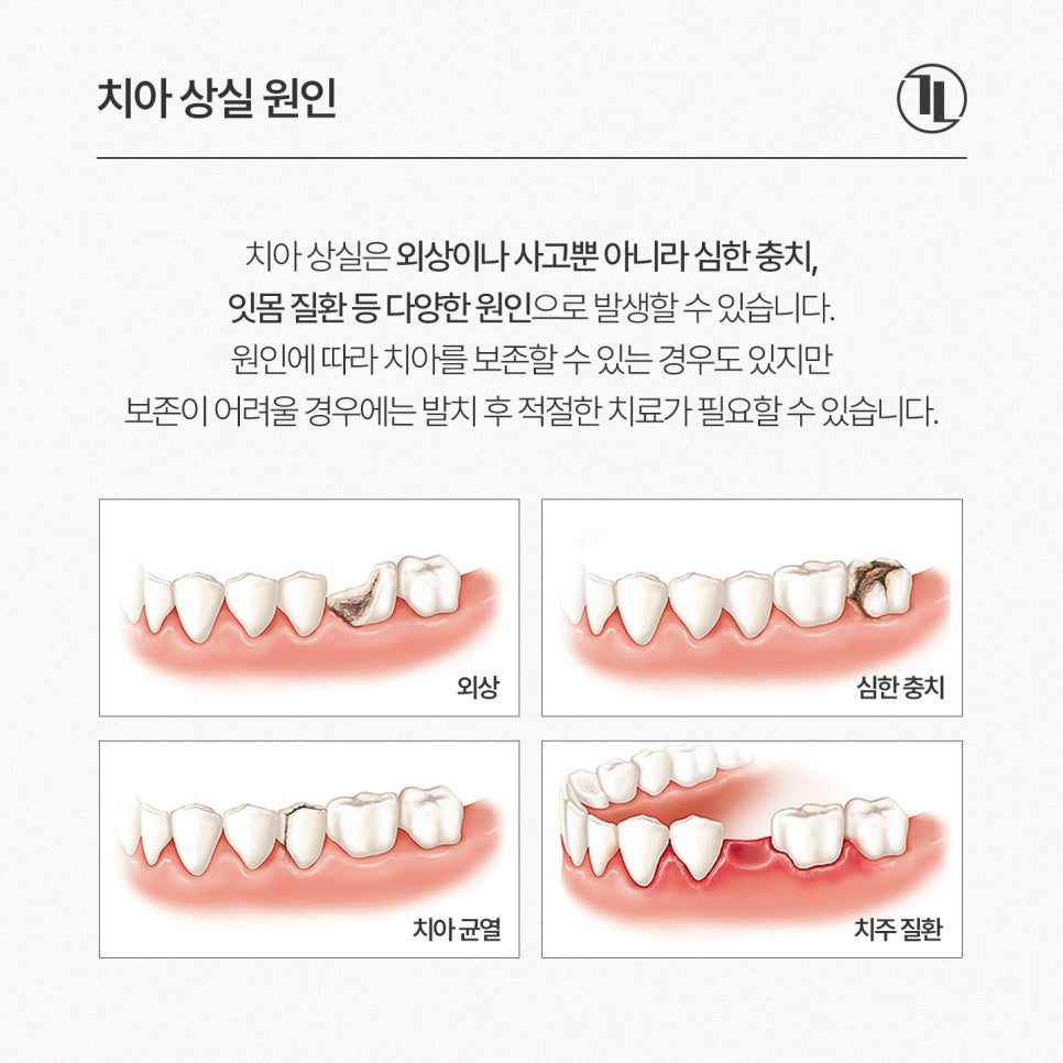 Lost a Front Tooth? Comparing Maryland Bridges, Traditional Bridges, and Implants / Gangnam Leon Dental Clinic image 2