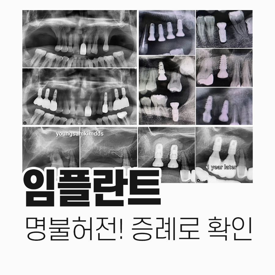 강남레옹치과 임플란트 수술 증례 한눈에 보기, 명불허전! 관련 이미지 1