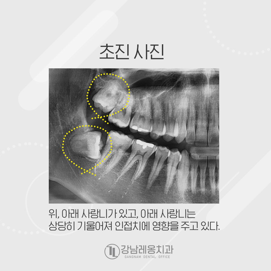강남레옹치과 위아래 2개 사랑니발치 시간, 가격? 당일 가능? 관련 이미지 2