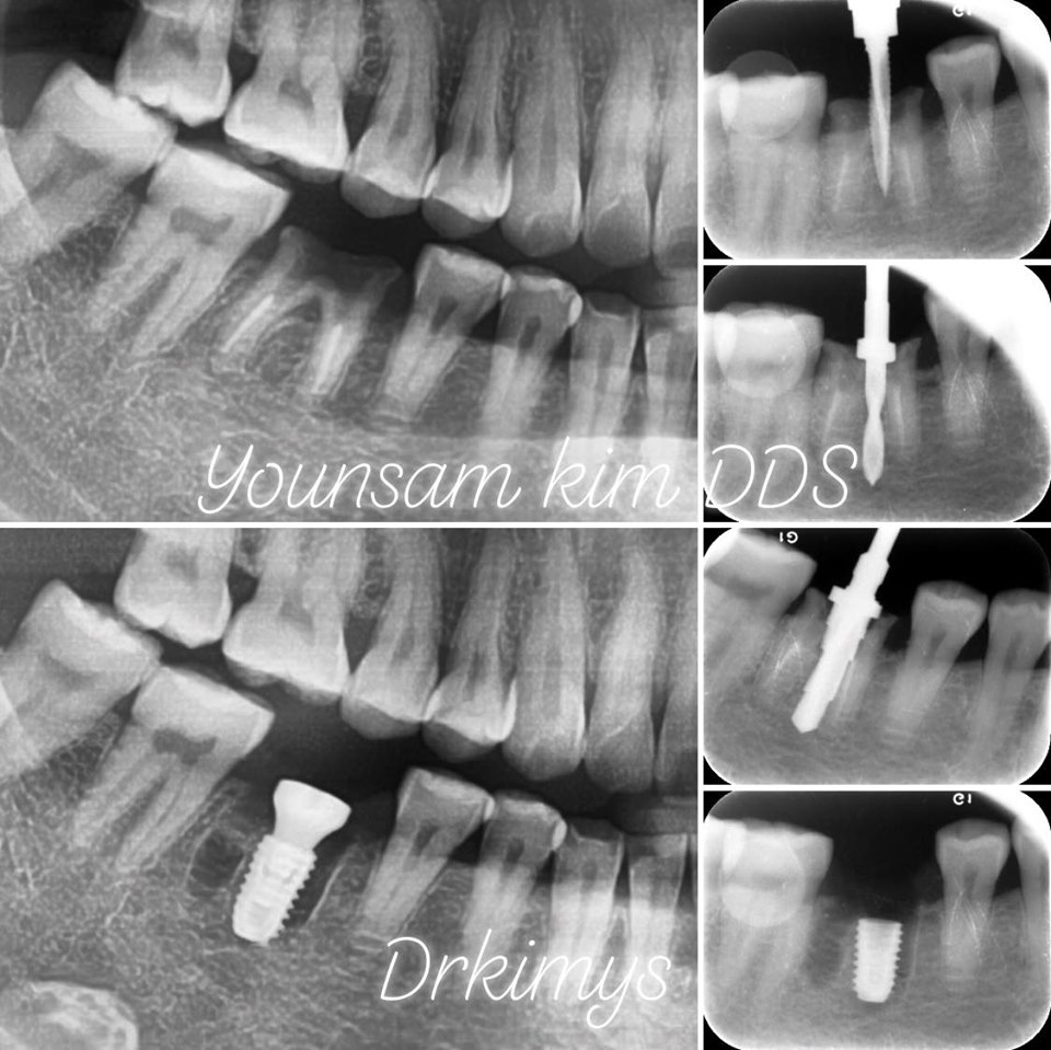 강남레옹치과 원데이 임플란트, 발치 즉시 식립까지 완료 관련 이미지 4