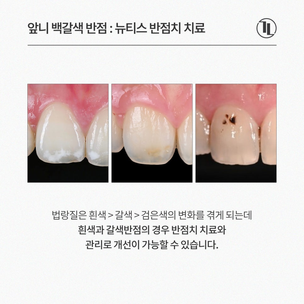 앞니 하얀점, 뉴티스 반점치 제거로 당일 개선 / 강남레옹치과 관련 이미지 3