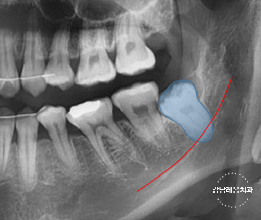 사랑니 발치, 왜 어떤 경우에 대학병원을 권유할까? / 강남레옹치과 관련 이미지 5