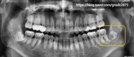 뿌리를 남긴 사랑니 발치? / 강남역 사랑니발치 강남레옹치과 관련 이미지 3