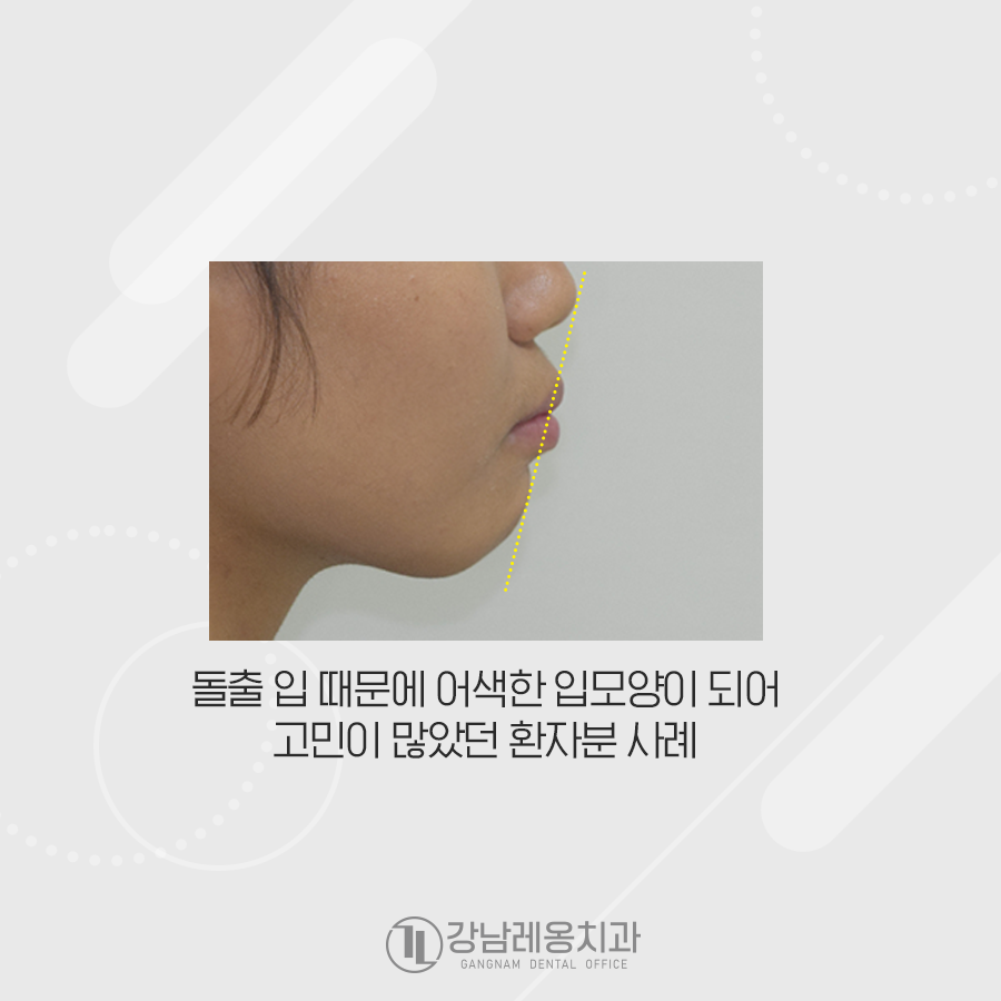 강남레옹치과 치아 교정, 돌출입 두가지 케이스 관련 이미지 6