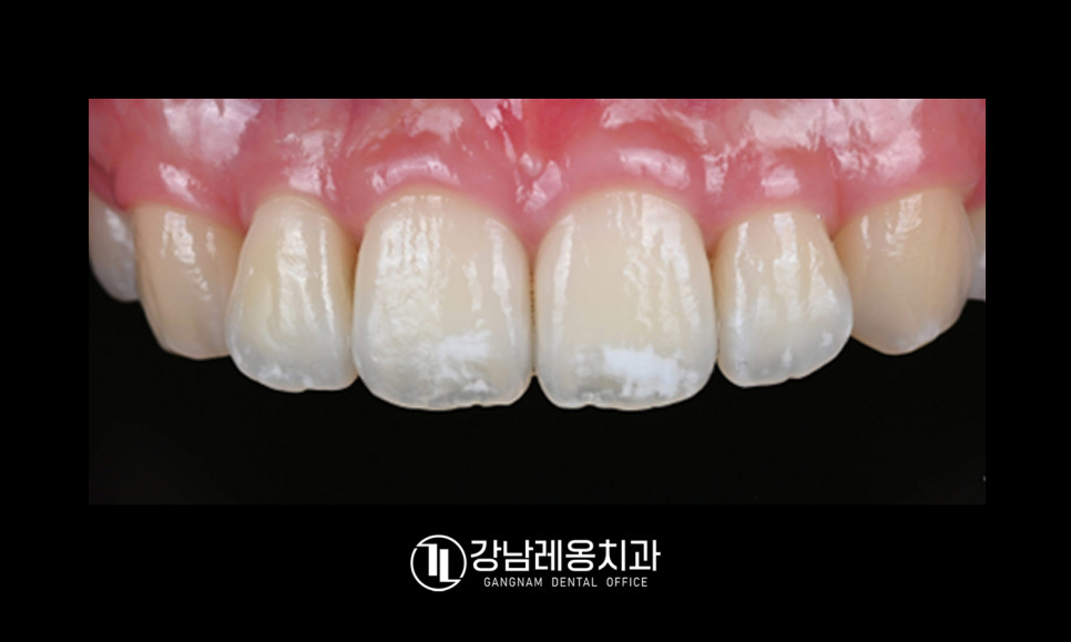 앞니 하얀점, 앞니 반점치 삭제없이 치료! / 아이콘 레진 치료 / 강남레옹치과 관련 이미지 5
