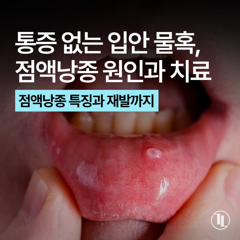 입술 안쪽에 말랑한 멍울, 그냥 둬도 괜찮을까? / 점액낭종 특징과 치료 / 강남레옹치과 관련 이미지 1