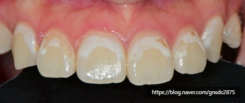 교정 후 치아에 백색반점이? 교정 후 치아탈회 삭제없이 뉴티스 반점치 치료 (아이콘레진) / 강남레옹치과 관련 이미지 3