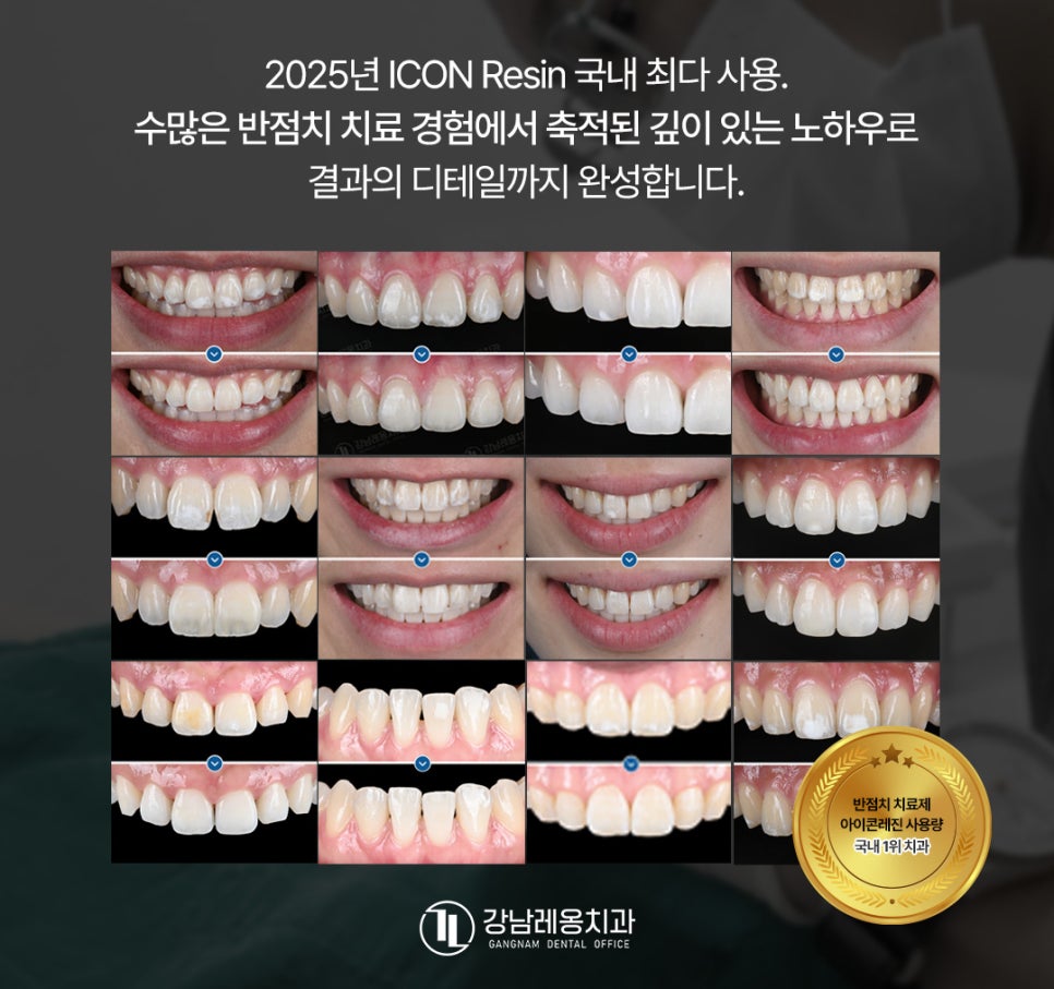 Must Check Before Treating White Spots / Icon Resin Features, Process, and Precautions / Gangnam Leen Dental Clinic image 7