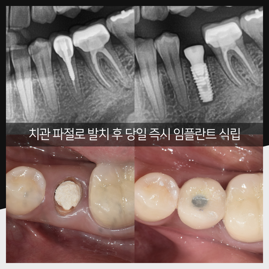 강남레옹치과 임플란트 수술 증례 한눈에 보기, 명불허전! 관련 이미지 5