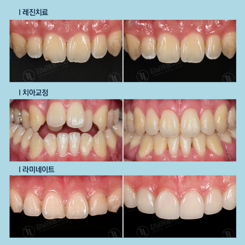 강남레옹치과 뉴티스, 라미네이트 말고도 예쁜 앞니 되찾는 법!? 관련 이미지 7