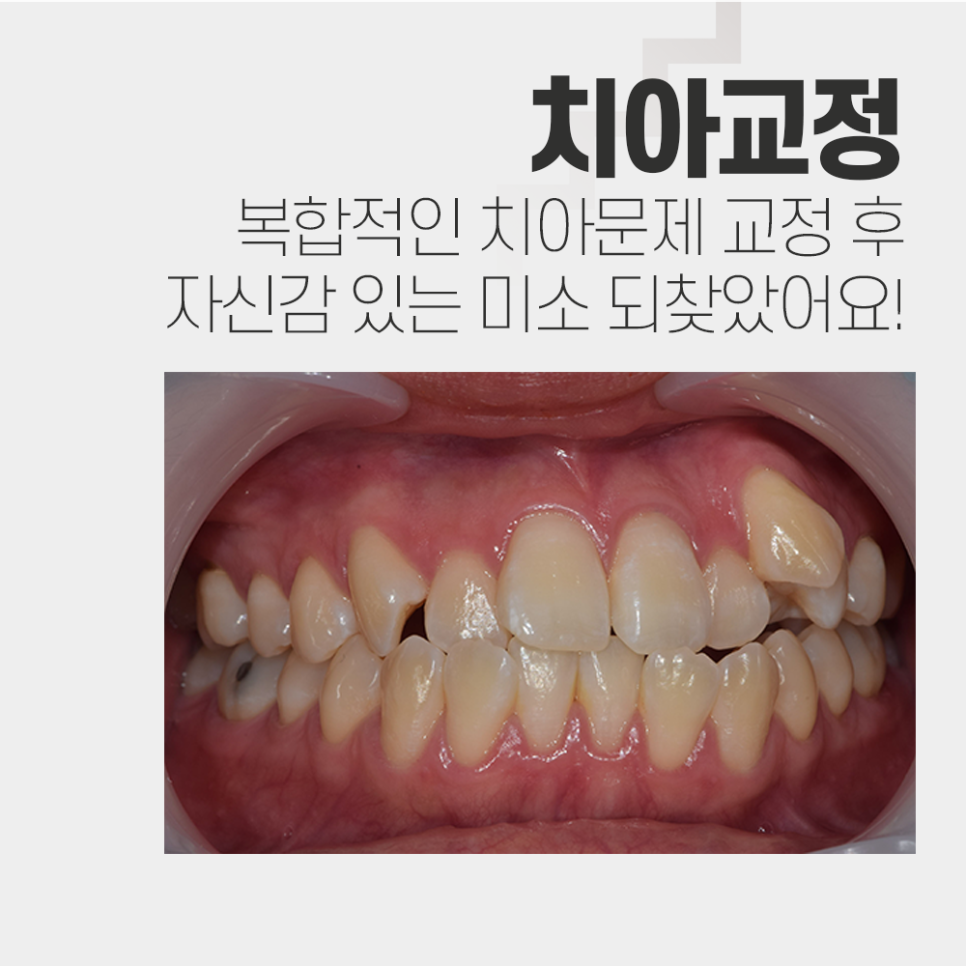 복합적인 구강의 문제를 치아교정으로 해결한 증례 관련 이미지 1