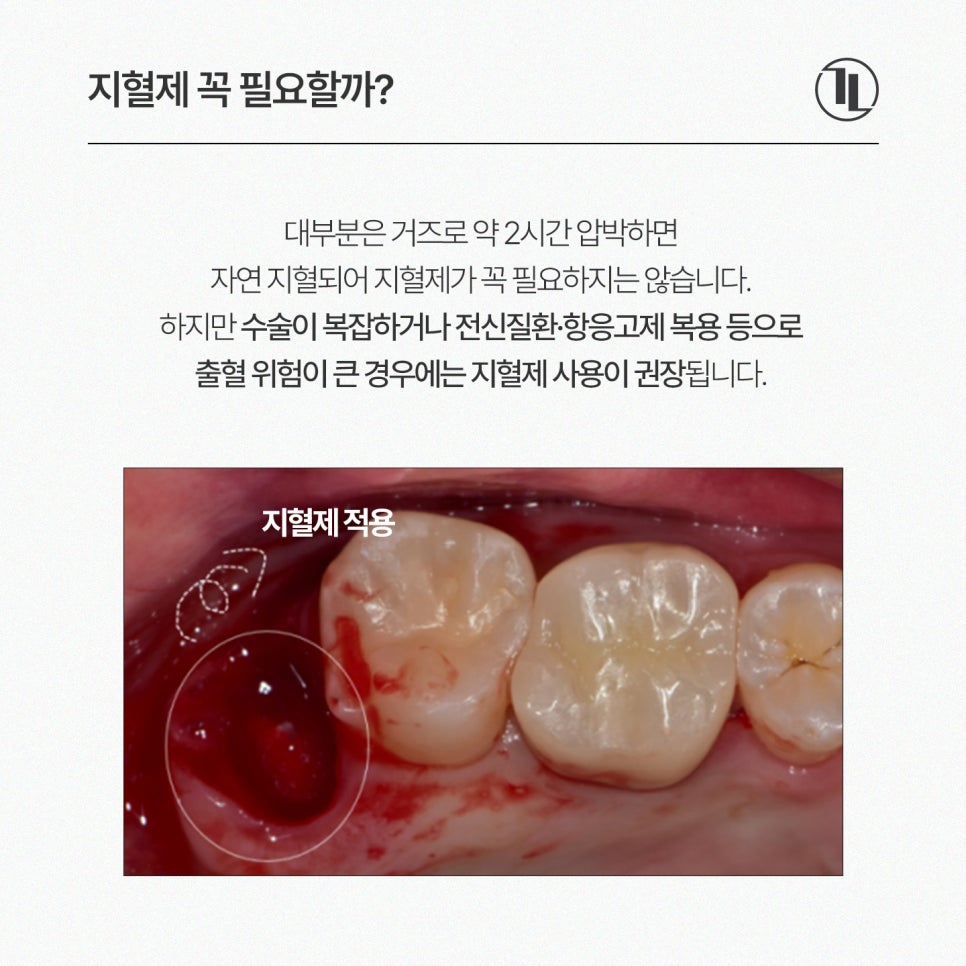 Is a Hemostatic Agent Really Necessary for Wisdom Tooth Extraction? Hemostatic Agent Usage Criteria, Insurance Coverage, and Cost / Gangnam Leon Dental Clinic image 3