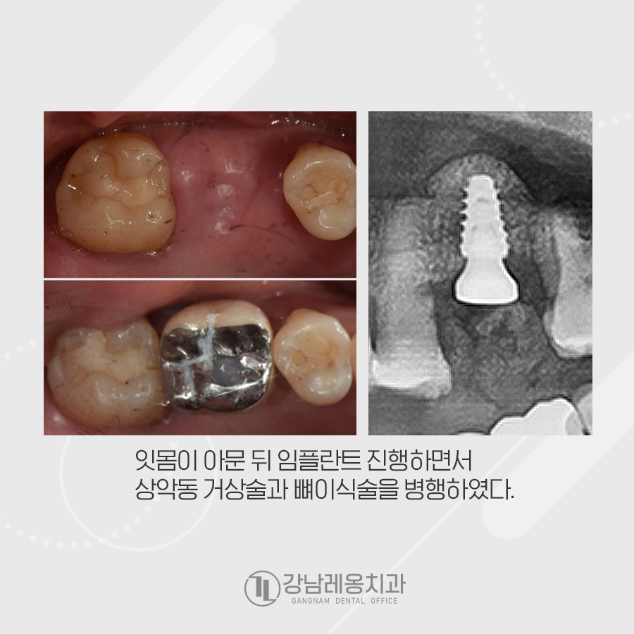 치주질환이 심하여 발치를 한 뒤 임플란트수술 관련 이미지 4
