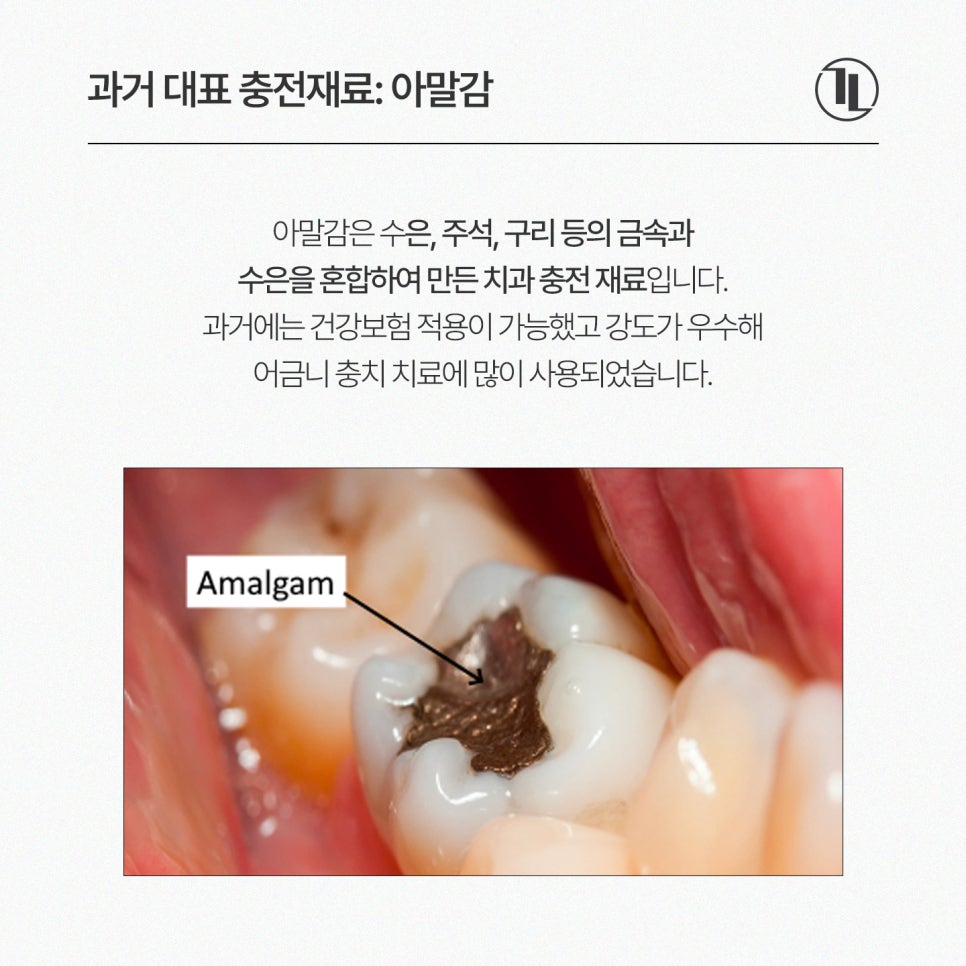 Should You Replace Dental Amalgam? Reasons and Necessity for Amalgam Replacement / Gangnam Leong Dental Clinic image 2