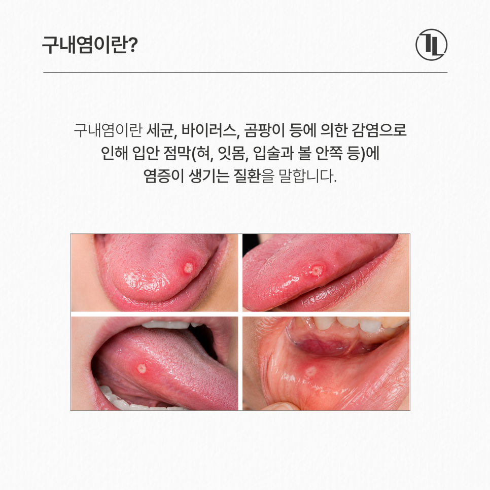 혀에 자꾸 구내염이 생긴다면? 원인부터 치료 관리법까지 / 강남레옹치과 관련 이미지 3