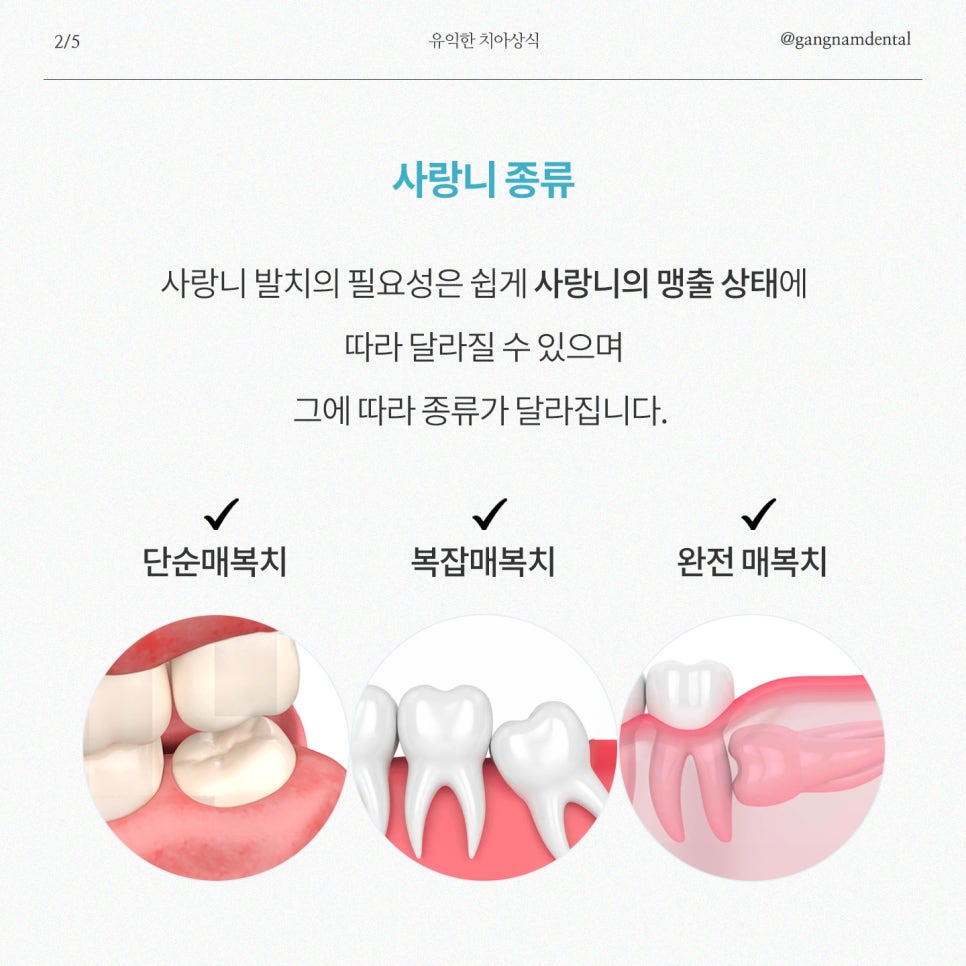사랑니 발치에 대한 모든것, 사랑니 총정리! / 종류, 비용, 발치과정, 관리, Q&A까지! / 강남레옹치과 관련 이미지 3