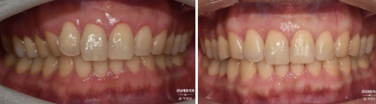 인비절라인 특징&middot;후기&middot;가격 총정리! 투명교정 완벽 가이드 / 강남역 교정치과 강남레옹치과 관련 이미지 6