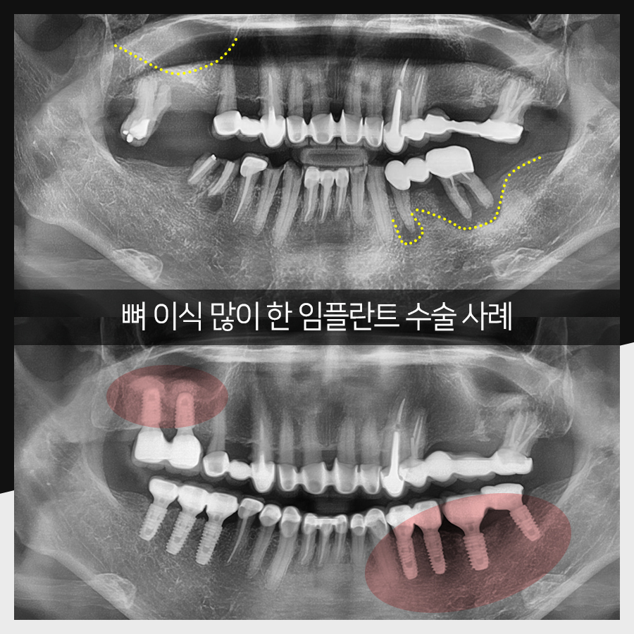 강남레옹치과 임플란트 수술 증례 한눈에 보기, 명불허전! 관련 이미지 2