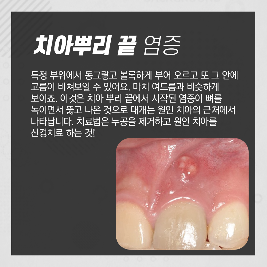 잇몸 부었을 때, 그 질환 원인과 치료법은 무엇일까요?? 관련 이미지 2