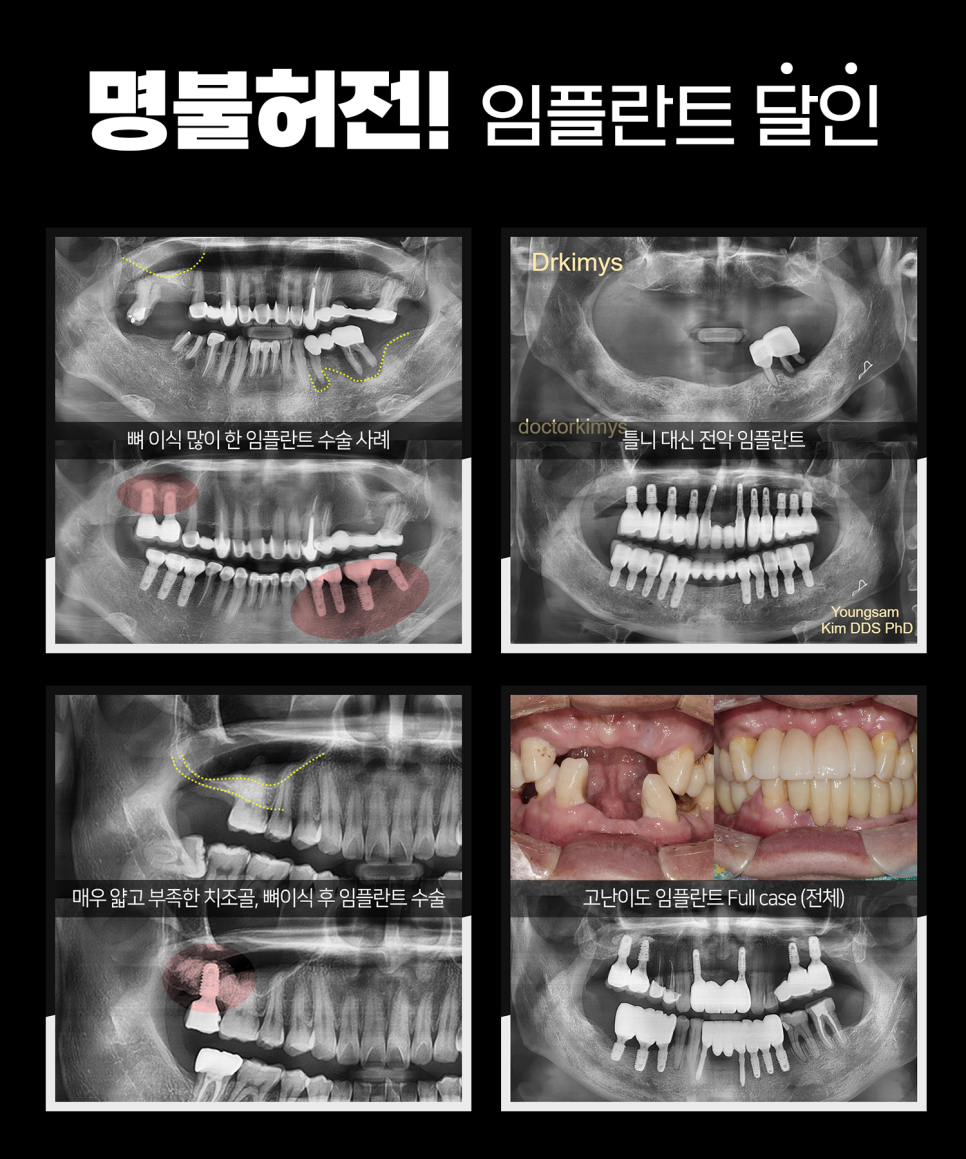 강남레옹치과의 의식하 진정법 임플란트! 통증, 불안 줄여요. 관련 이미지 2