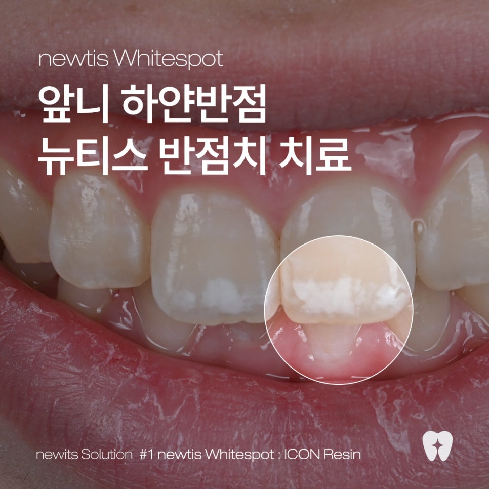 앞니 하얀얼룩 아이콘레진으로 말끔하게 / 뉴티스 반점치치료 / 강남레옹치과 관련 이미지 1