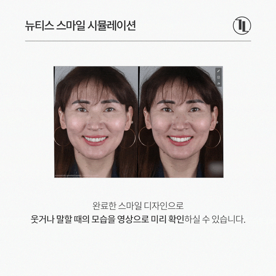 뻐드러진 나비앞니, 시술 전 스마일 시뮬레이션 후 뉴티스라미 관련 이미지 4