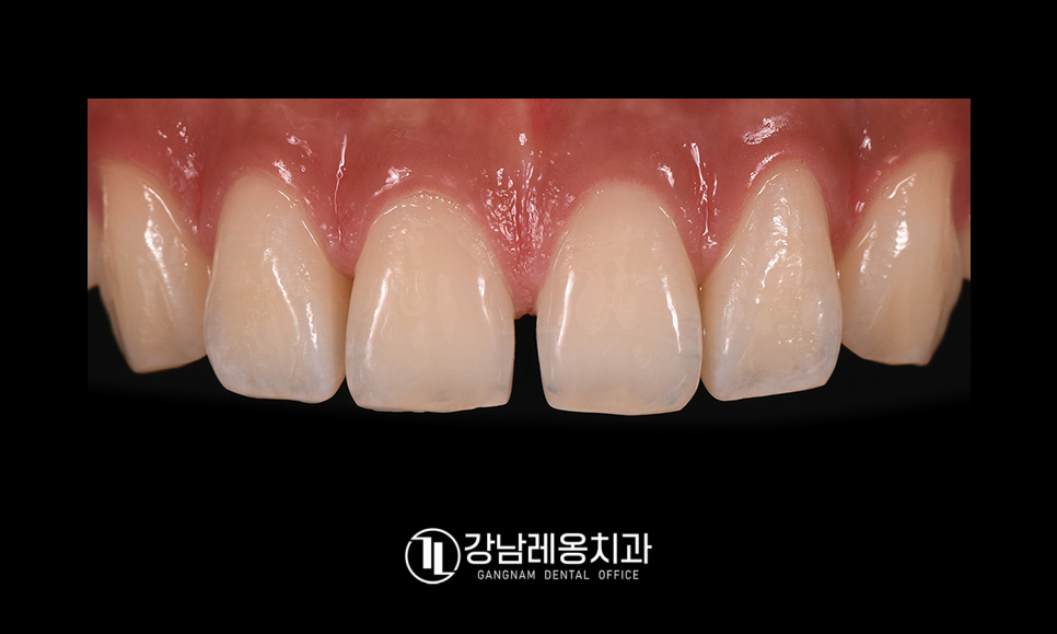 앞니 벌어짐 치료 후기 / 아이 앞니 벌어짐 건강하게 치료하려면? / 강남레옹치과 관련 이미지 3