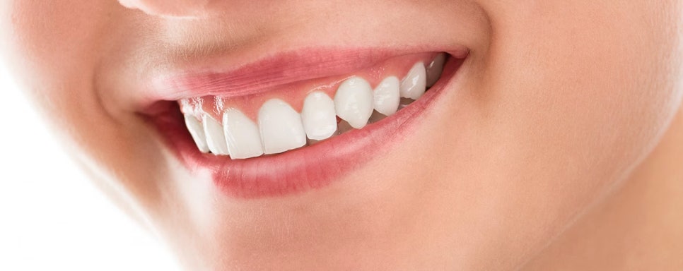 잇몸미백 효과 있나요? 시술 전후와 유지기간, 부작용까지!  / 강남레옹치과 뉴티스 잇몸미백 관련 이미지 2