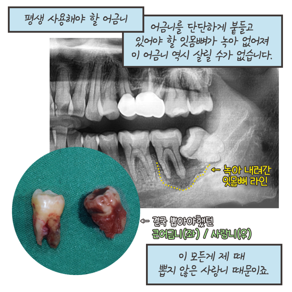 사랑니 안 뽑으면? 묻고 떠블로 가!! (냐폴레옹 치과툰) 관련 이미지 10