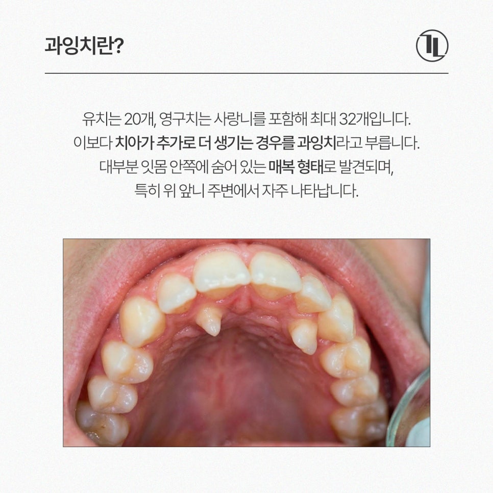 과잉치 원인부터 발치까지 / 과잉치 발치 과정 / 강남레옹치과 관련 이미지 2
