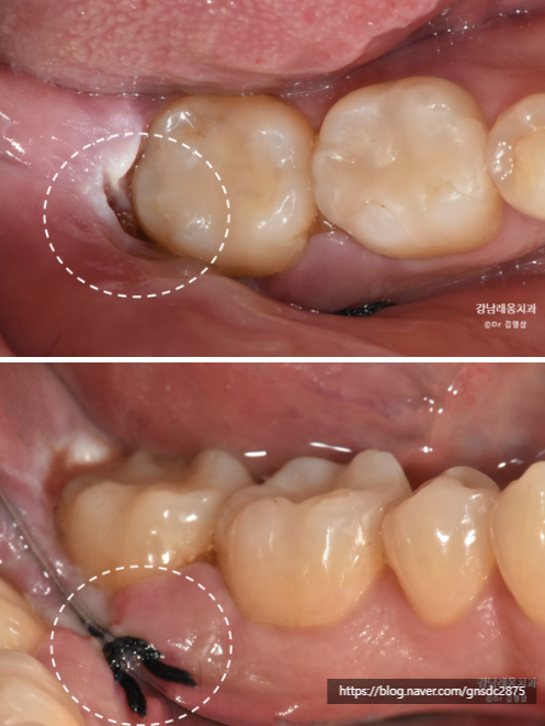뿌리를 남긴 사랑니 발치? / 강남역 사랑니발치 강남레옹치과 관련 이미지 7