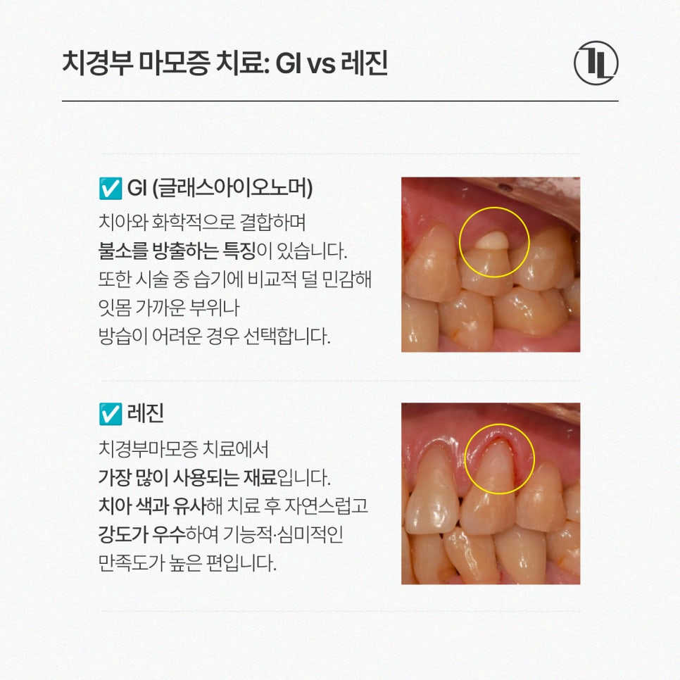 Tooth Notches and Tooth Sensitivity? Cervical Abrasion / Comparing Causes and Treatment Methods / Gangnam Leon Dental Clinic image 4