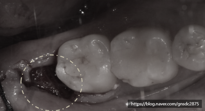 사랑니 발치 후 구멍, 음식물 끼임부터 회복, 관리법까지 총정리📑 / 강남레옹치과 관련 이미지 3