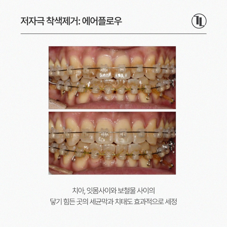 커피&middot;흡연 착색 치아 관리 첫 단계, 에어플로우 착색 제거 / 강남레옹치과 관련 이미지 3