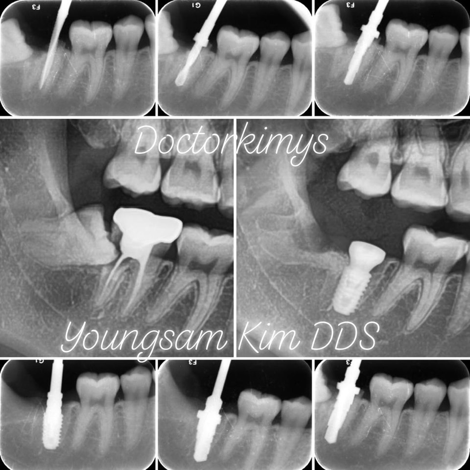 강남레옹치과 원데이 임플란트, 발치 즉시 식립까지 완료 관련 이미지 1
