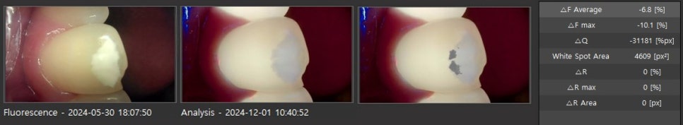 앞니에 하얀얼룩이? 앞니 길이가 달라요! / 앞니통합치료 뉴티스 반점치료 + 치아성형✨ / 강남레옹치과 관련 이미지 4