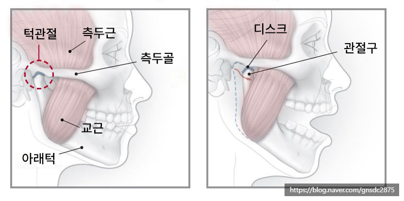 보톡스의 또 다른 활용법? 턱관절 통증 치료💉 / 강남레옹치과 관련 이미지 2