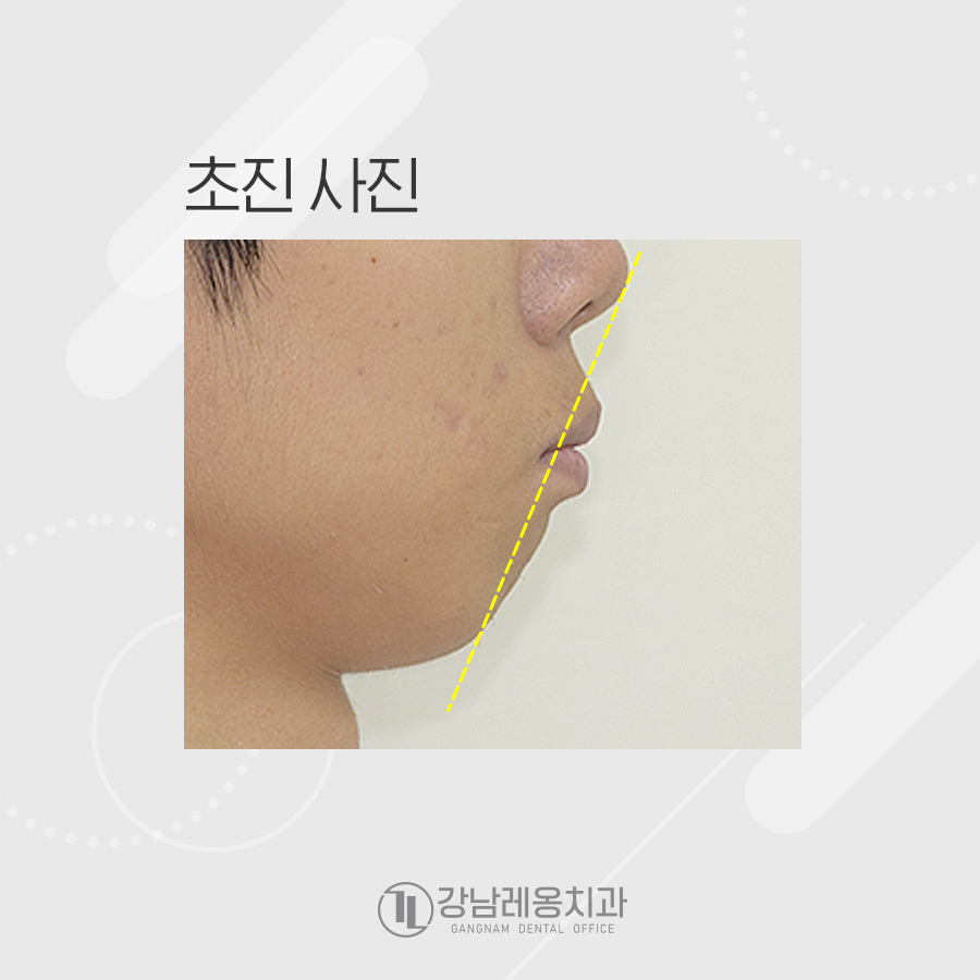 앞니 뻐드러짐 치아 교정으로 돌출입 들어간 케이스 관련 이미지 2