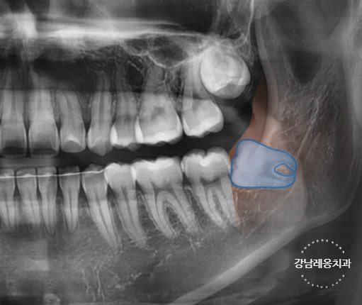 사랑니 발치, 왜 어떤 경우에 대학병원을 권유할까? / 강남레옹치과 관련 이미지 3