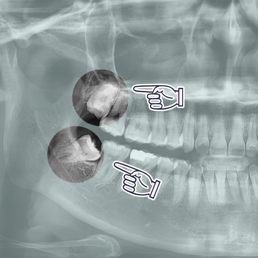 매복 사랑니발치 비용, 강남레옹치과 증례를 보며 알아봐요. 관련 이미지 3
